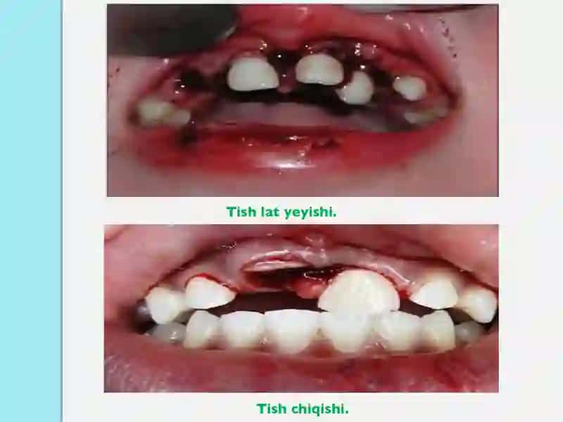 Tish chiqqandan keyin paydo bo’ladigan nokariyes kasalliklar. Tishlarni mexanik va kimiyoviy jarohatlari. Klinikasi, tashxislash va qiyosiy tashxisi. 3