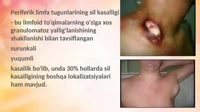 Periferik limfa tugunlari tuberkulozi bir necha kasalliklar bilan qiyosiy tashxislash 3