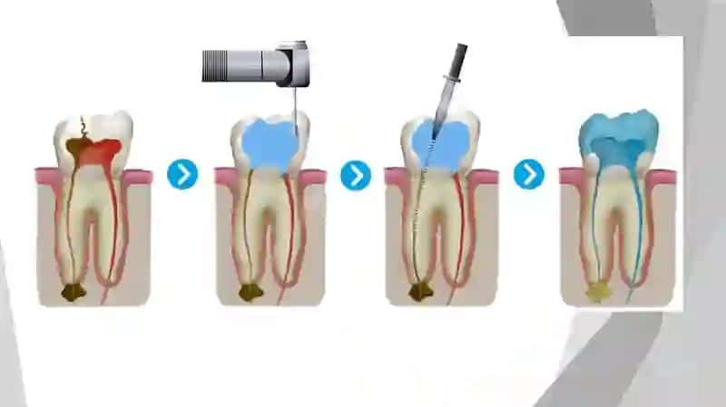 Endodontik asboblar 3