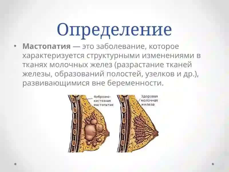 Мастопатия 3