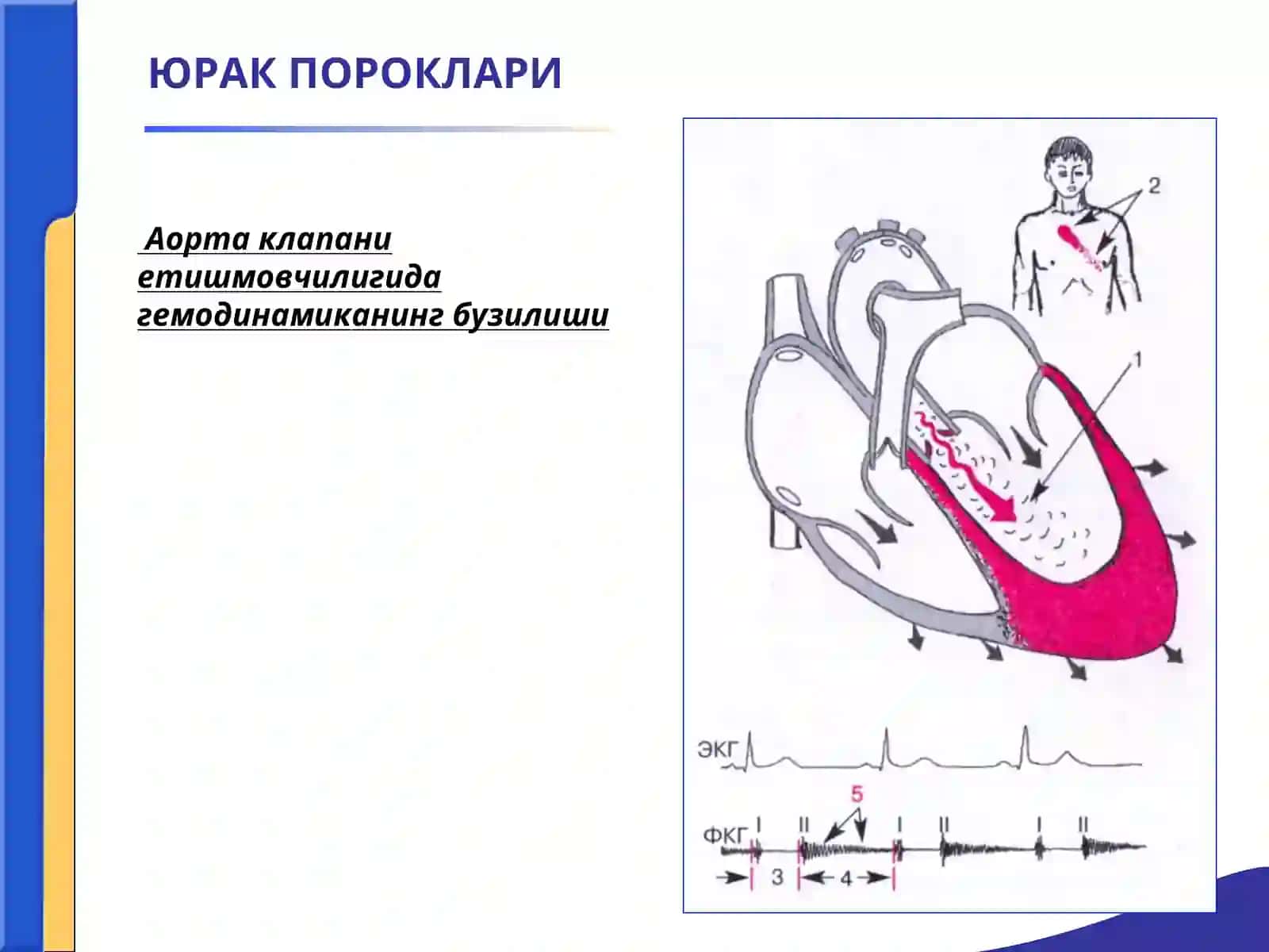 ЮРАК ПОРОКЛАРИ. АОРТА КЛАПАНИНИНГ ЕТИШМОВЧИЛИГИ.АОРТА ОҒЗИНИНГ СТЕНОЗИ.ҚОН АЙЛАНИШИ ЕТИШМОВЧИЛИГИ 3