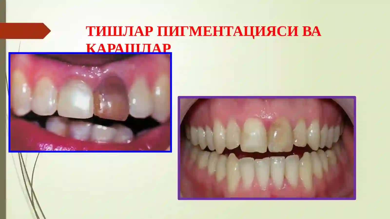 Tishqattiq to’qimasining nokariyeska salliklari darestavratsiyani kliniktamoyillari 3