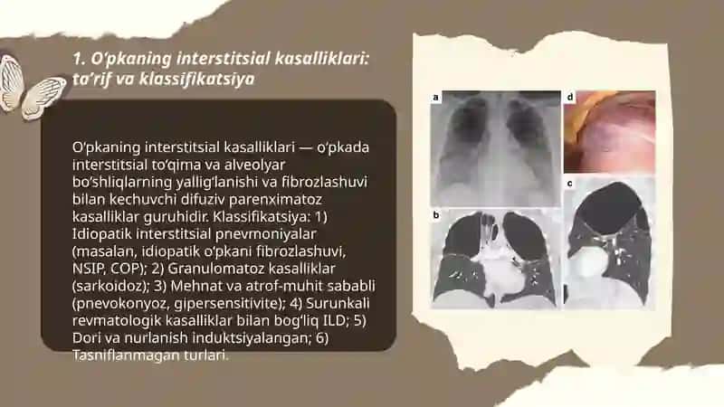O‘pkaning interstitsial kasalliklari 3