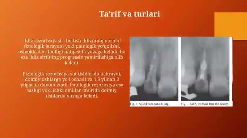 Ildiz rezorbsiyasi 3