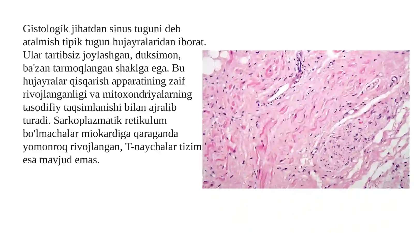Sinus tuguni zaifligi sindromi (2-variant) 3