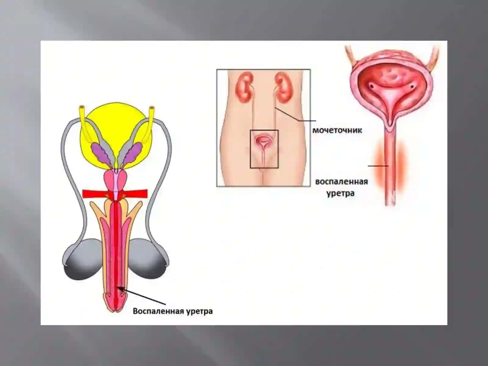 Uretrit.Orxit. Epididimit 3