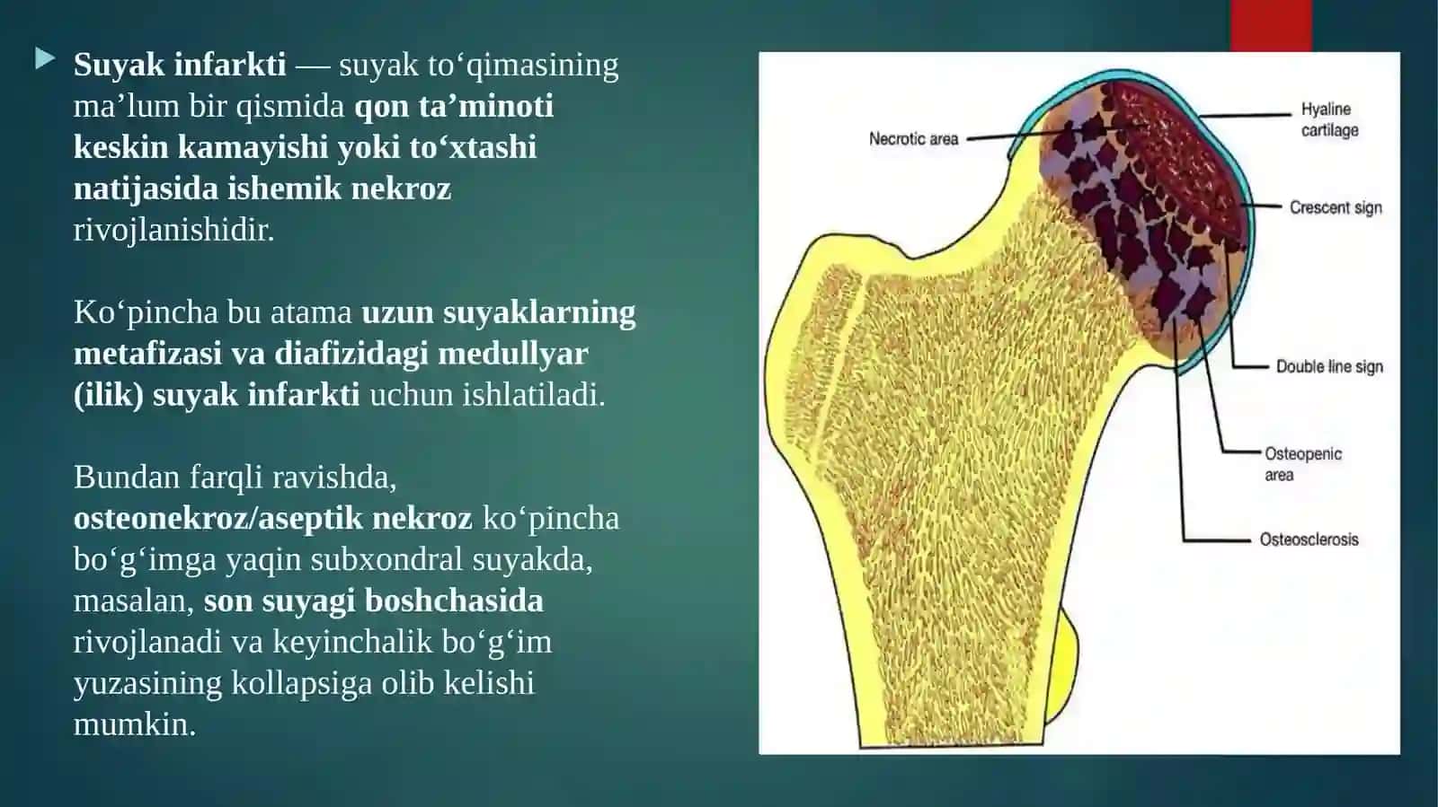 Suyakinfarkti 3