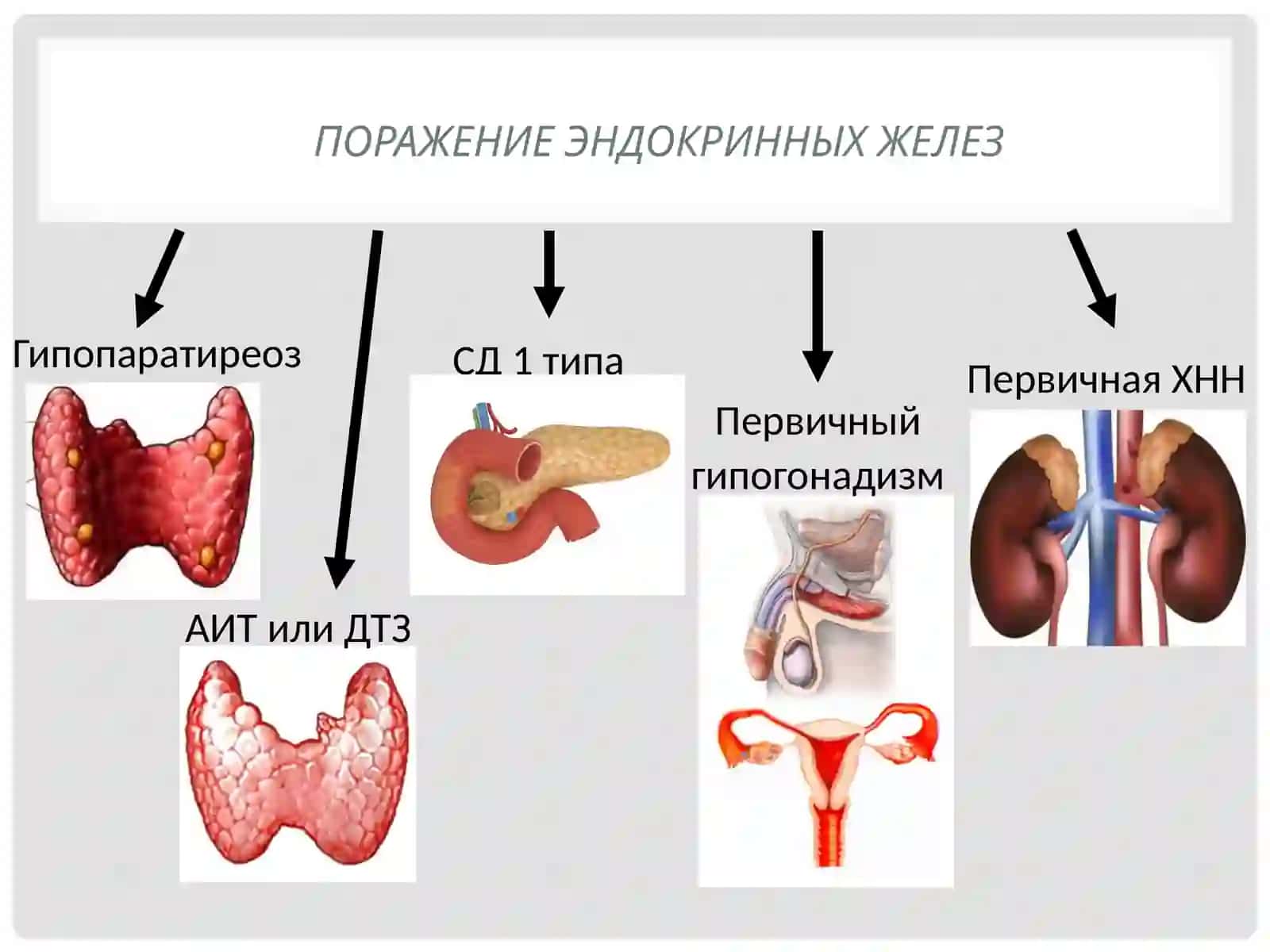 Аутоиммунныеполигландулярныесиндромы 3