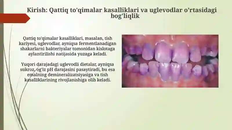 Tish qattiq to'qimasi kasalliklarini kelib chiqishida uglevodlarning ro'li 3