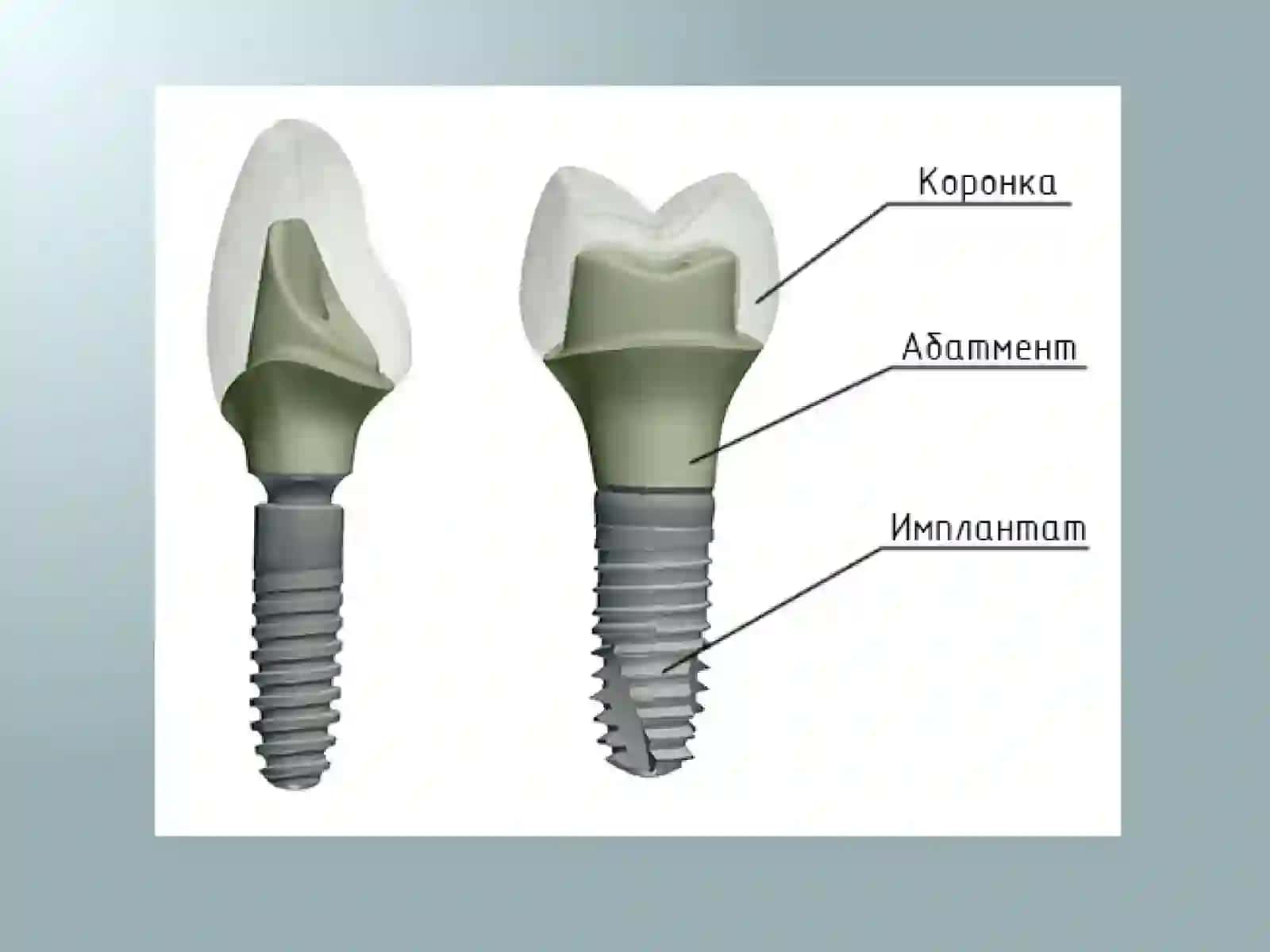 Implant 3