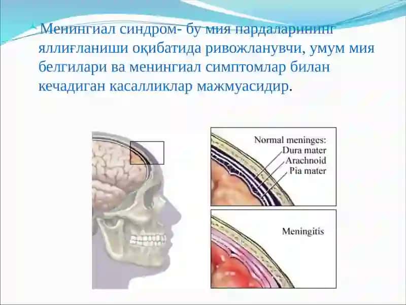 Менингиал синдром. Менингиал белгилар билан кечадиган касалликлар. 3