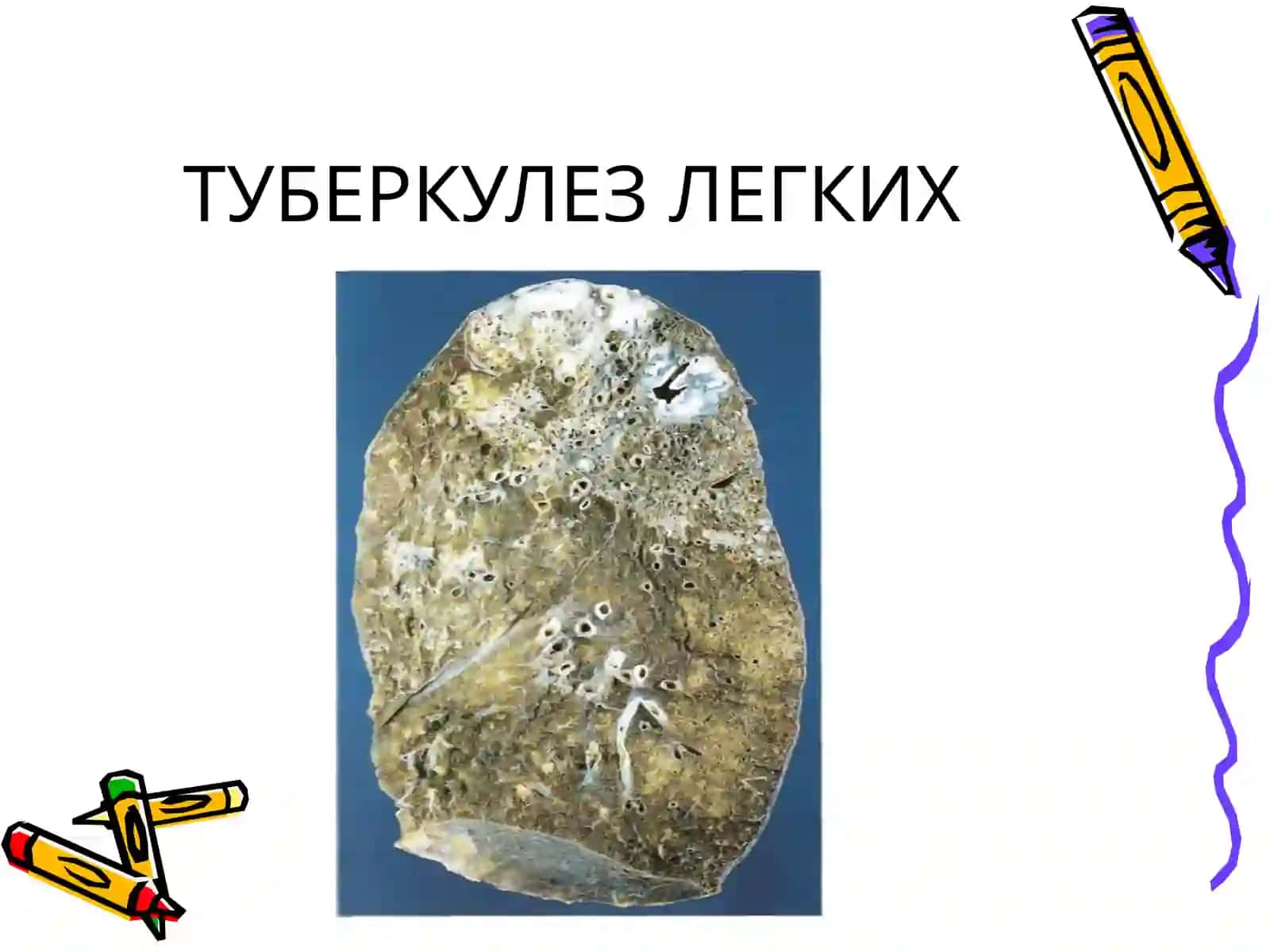 ТУБЕРКУЛЕЗ 3