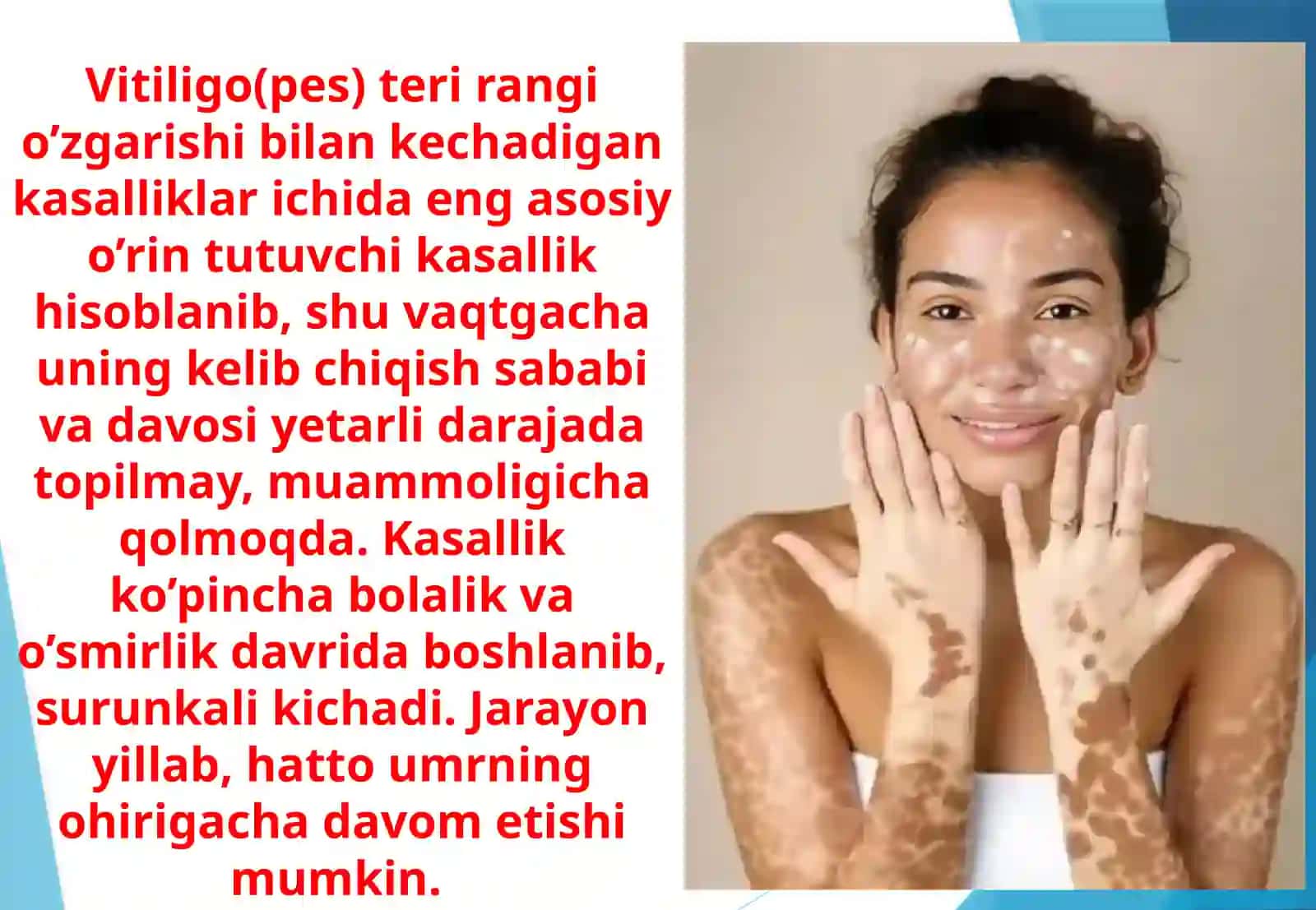 Vitiligo. Leyshmanioz. Moxov kasalligi 3