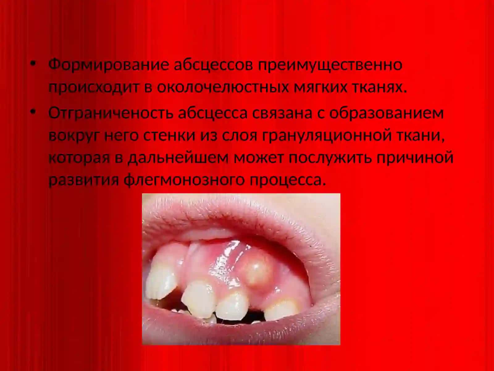 Абсцесс 3