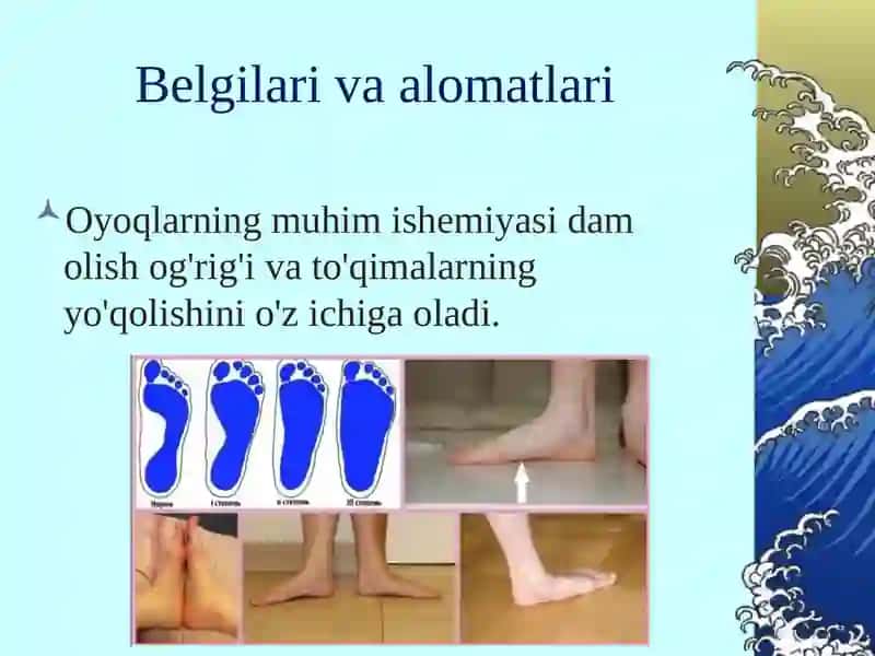 Surunkali oyoq-qo'llar gatahdid 3