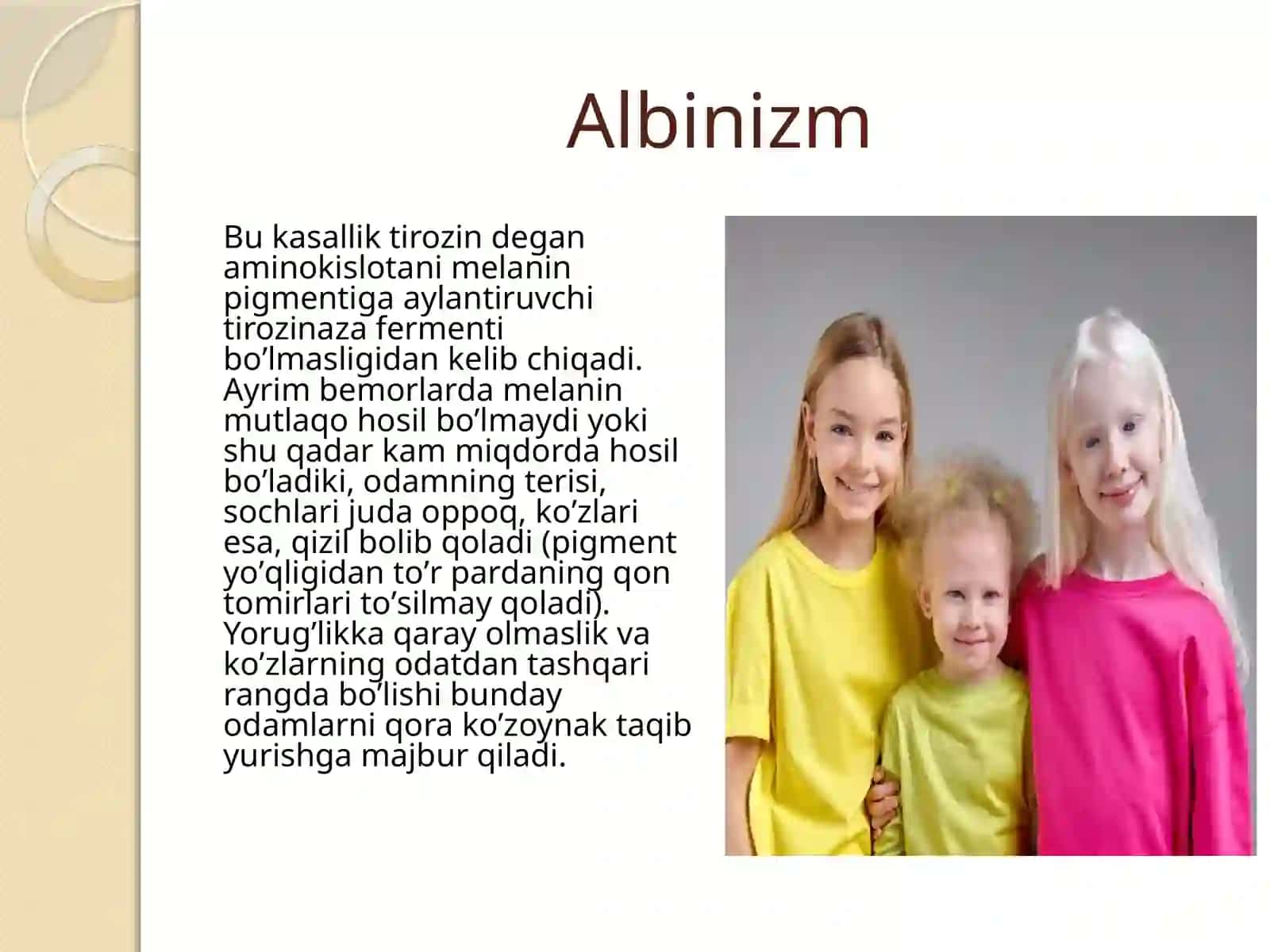 Albinizm 3