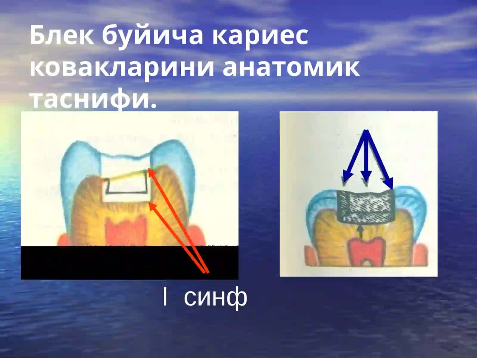 Кариес ковакларини анатомик таснифи 3