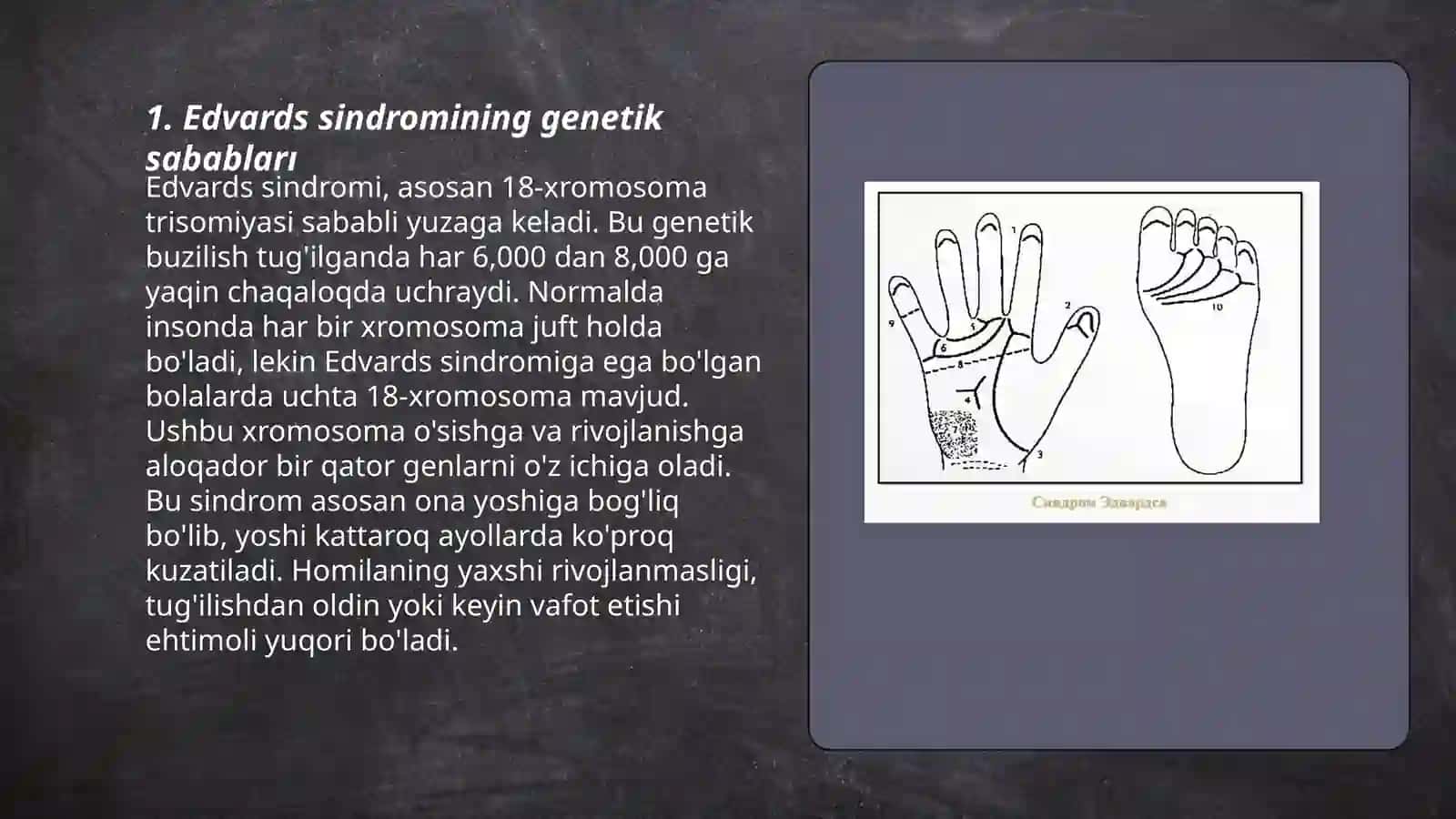 Edvards sindromi 3