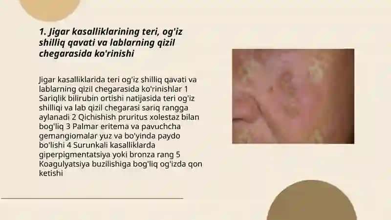 Jigar kasalliklarining teri 3