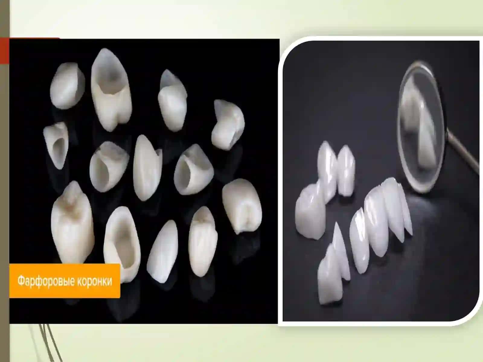 CHINNI, PLASTMASSA VA DIOKSID-SIRKON QOPLAMALARNING KLINIK-LABORATORIYA BOSQICHLARI 3