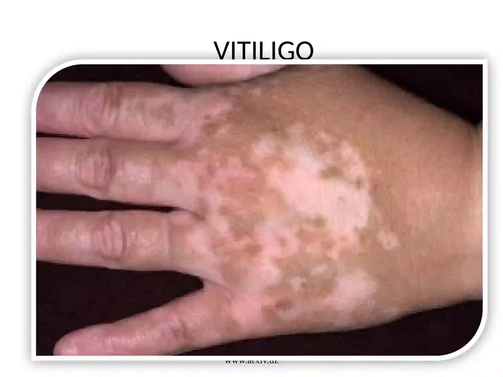 VITILIGO KASALLIGI 3