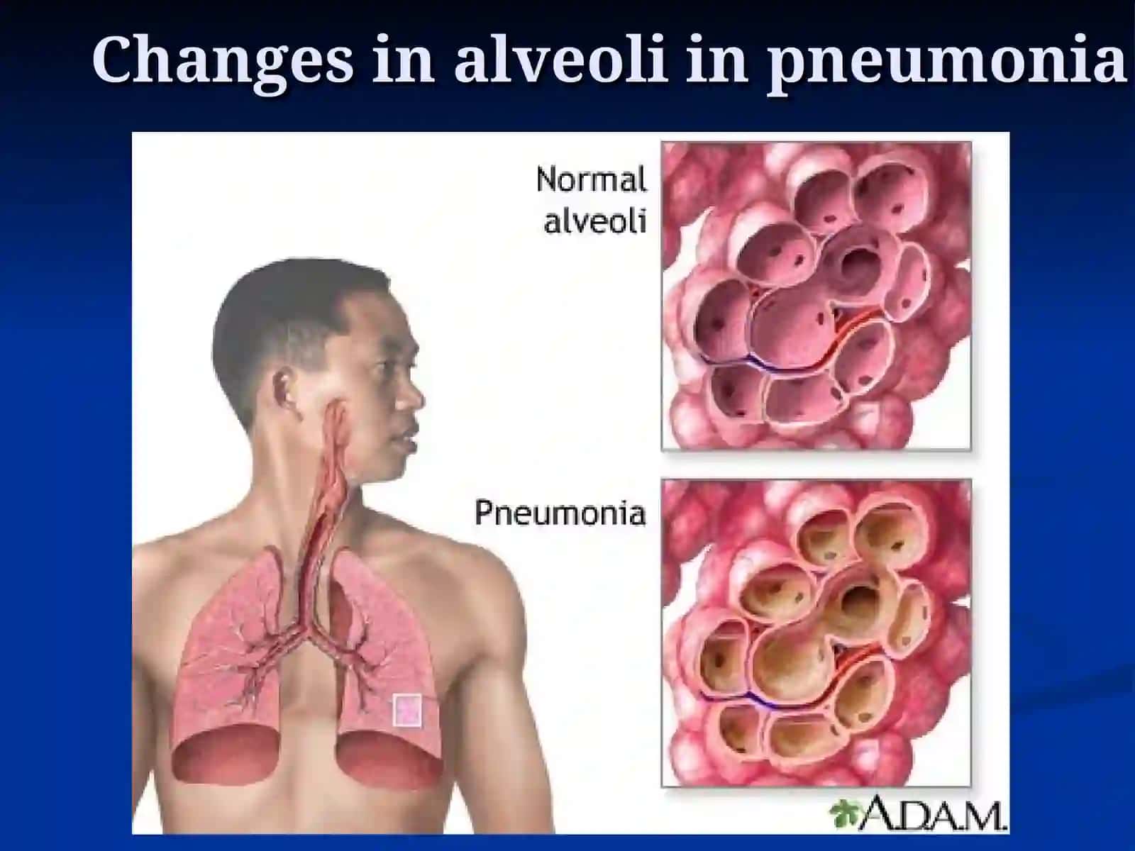 PNEUMONIA 3