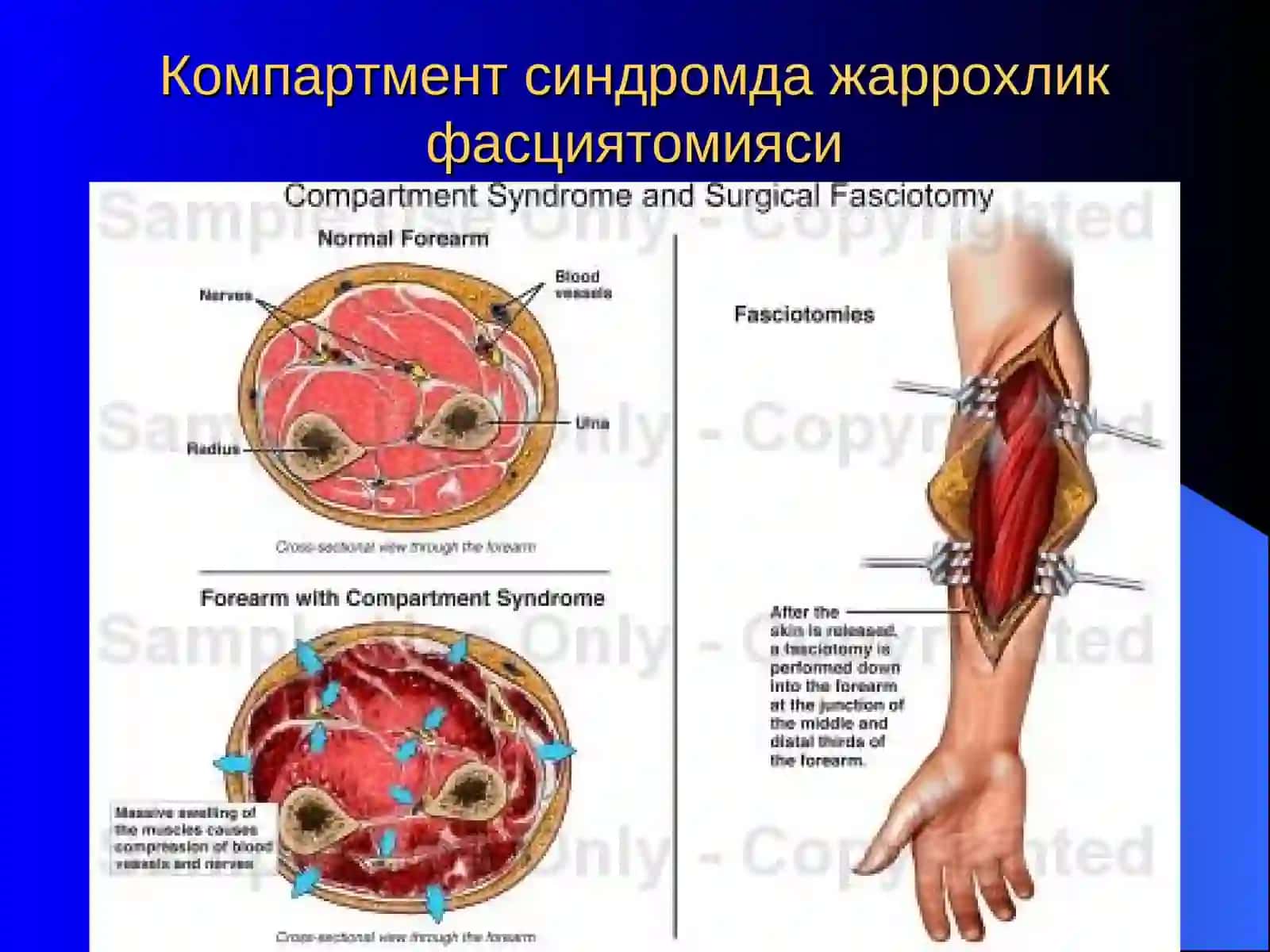 Компартмент синдром 3
