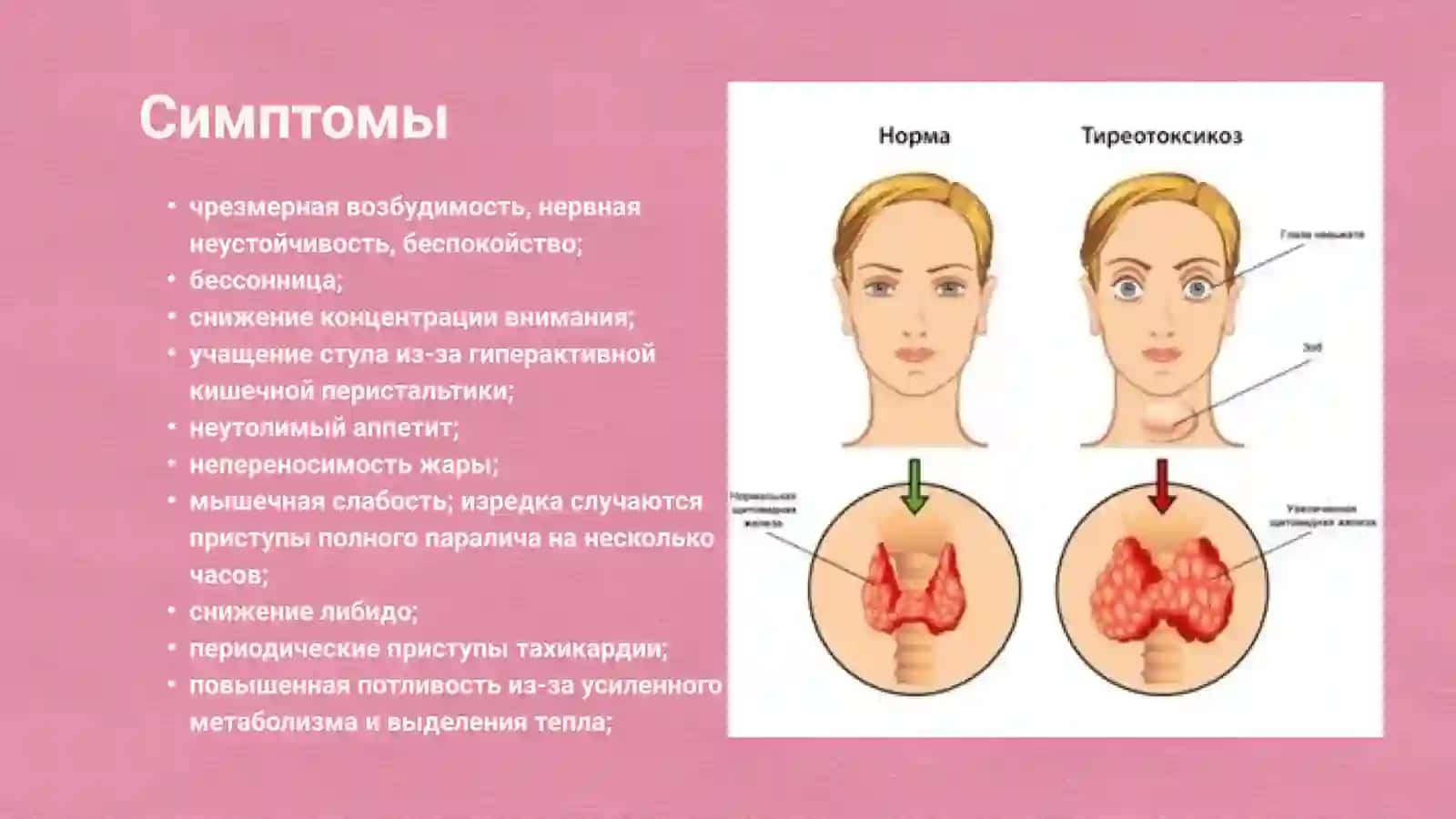 Профилактика и лечение тиреотоксикоза 3