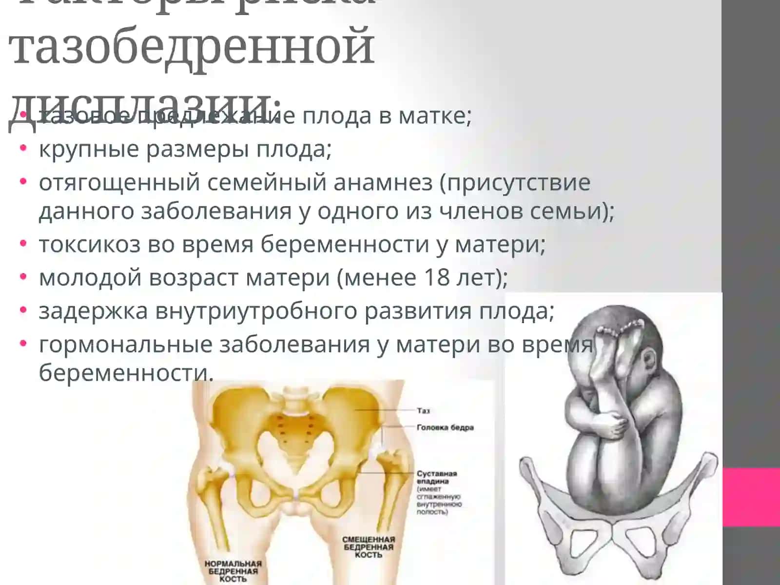 Врожденный вывих бедра(дисплазия тазобедренного сустава) 3