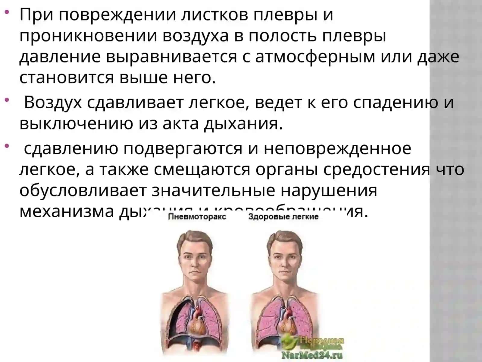 Пневмоторакс Классификация пневмоторакса 3