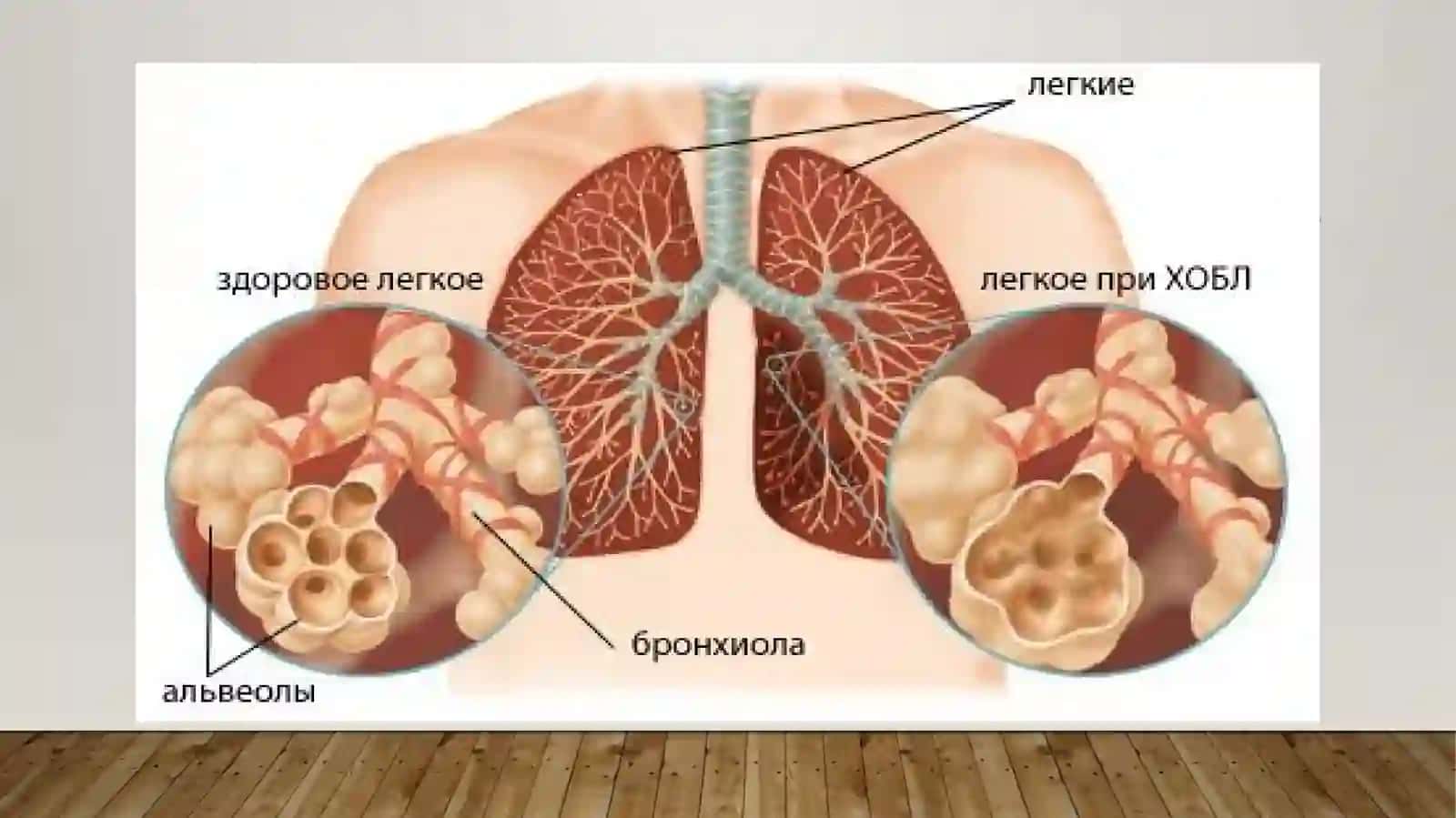 Bronxoobstruktiv sindromiqiyosiy tashxisi 3