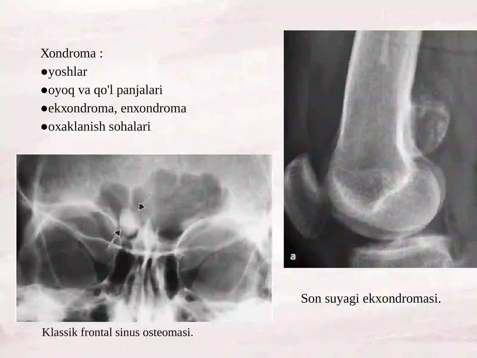 Suyakning xavfsiz o'smаlаri(оstеоmа, хоndrоmа, оstеохоndrоmа, fibrоmа, gеmаngiоmа) 3