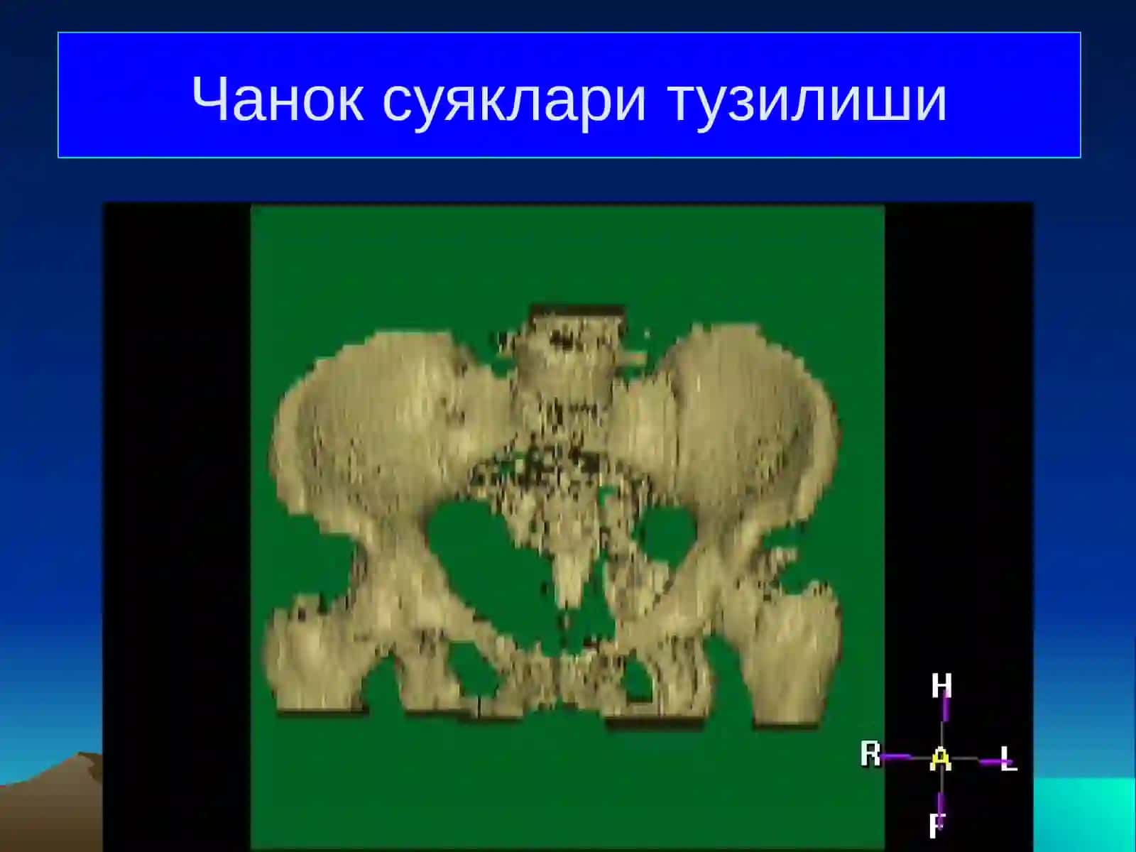 Чанок суяклари ва умуртка погонаси синишлари 3