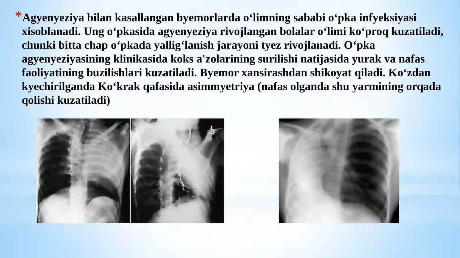 O’pkaning tug‘ma rivojlanish nuqsonlari va an’omali yalari 3