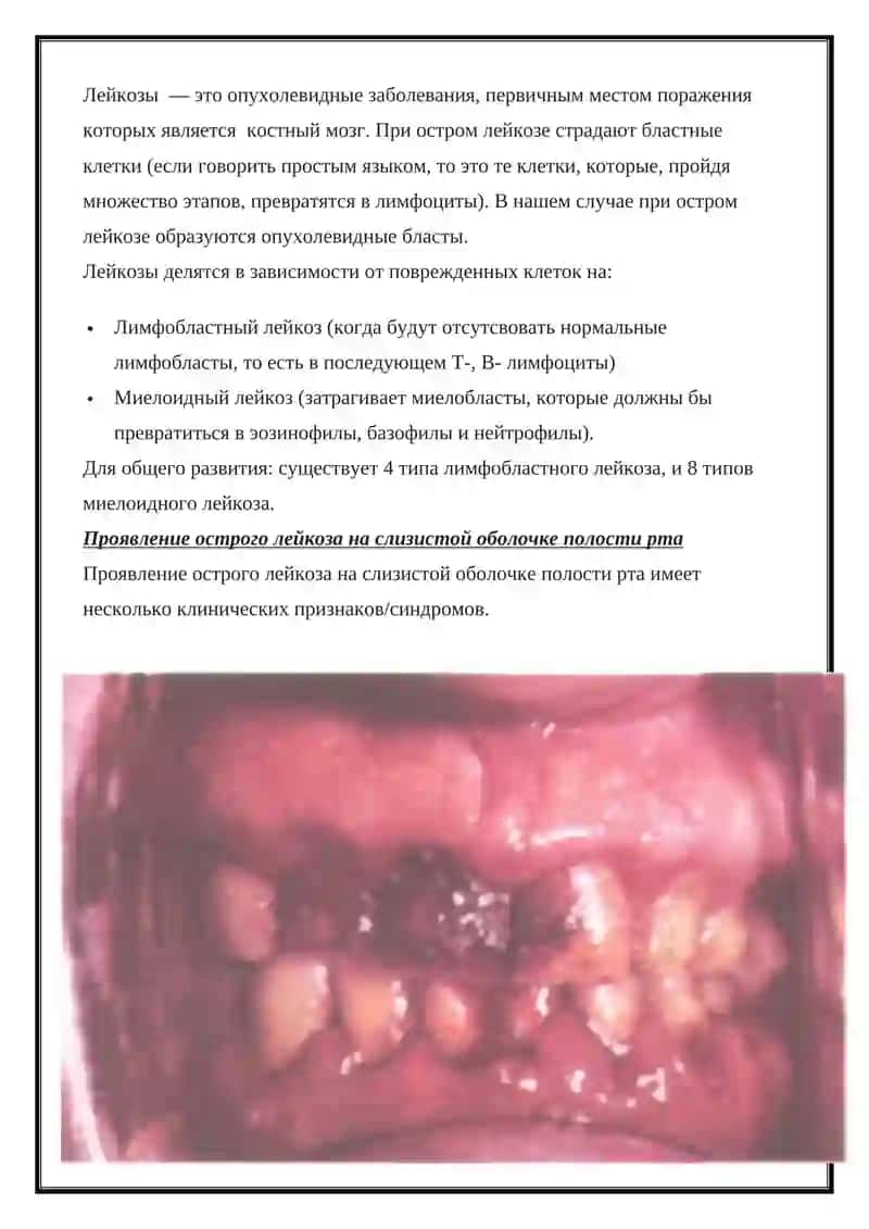 Гемобластозы 3