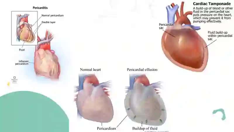 DISEASES OF THE PERICARDIUM. TUMORS OF THE HEART. HEART TRANSPLANTATION. 3