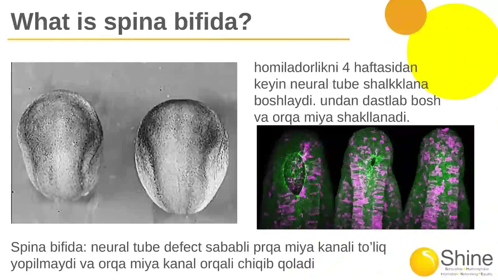 Spina bifida 3