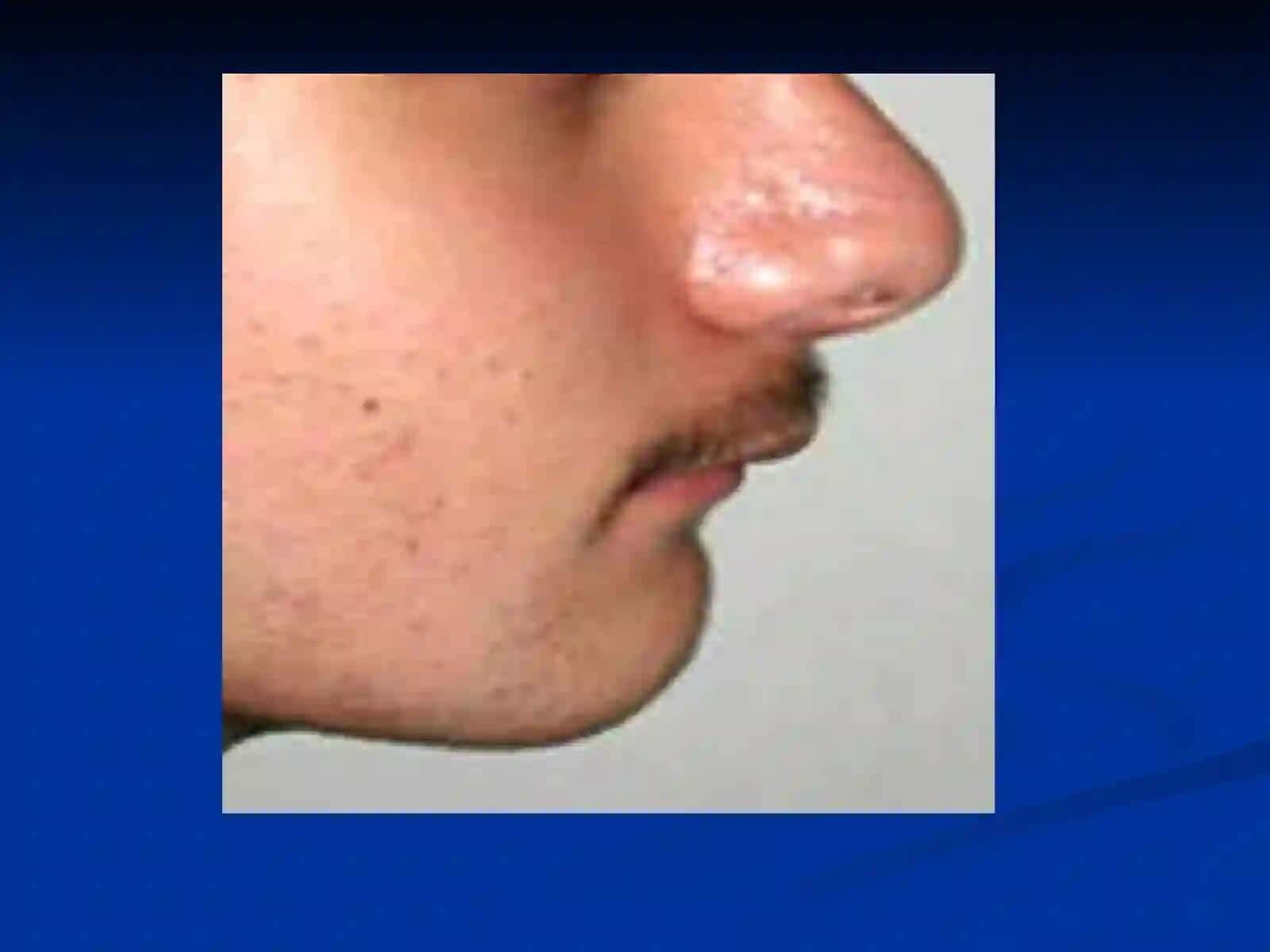 Distal prikus anomaliyalari 3