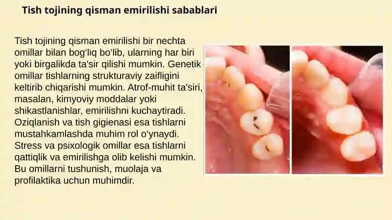 Tish tojining qisman yemirilishi. Blek bo'yicha bo‘shliqlar tasnifi. Melikevichga ko'ra IROPZ. 3