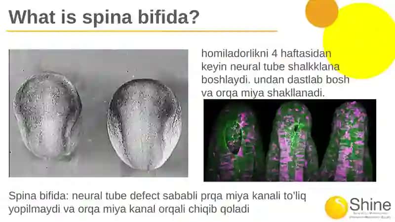 Spinabifida 3