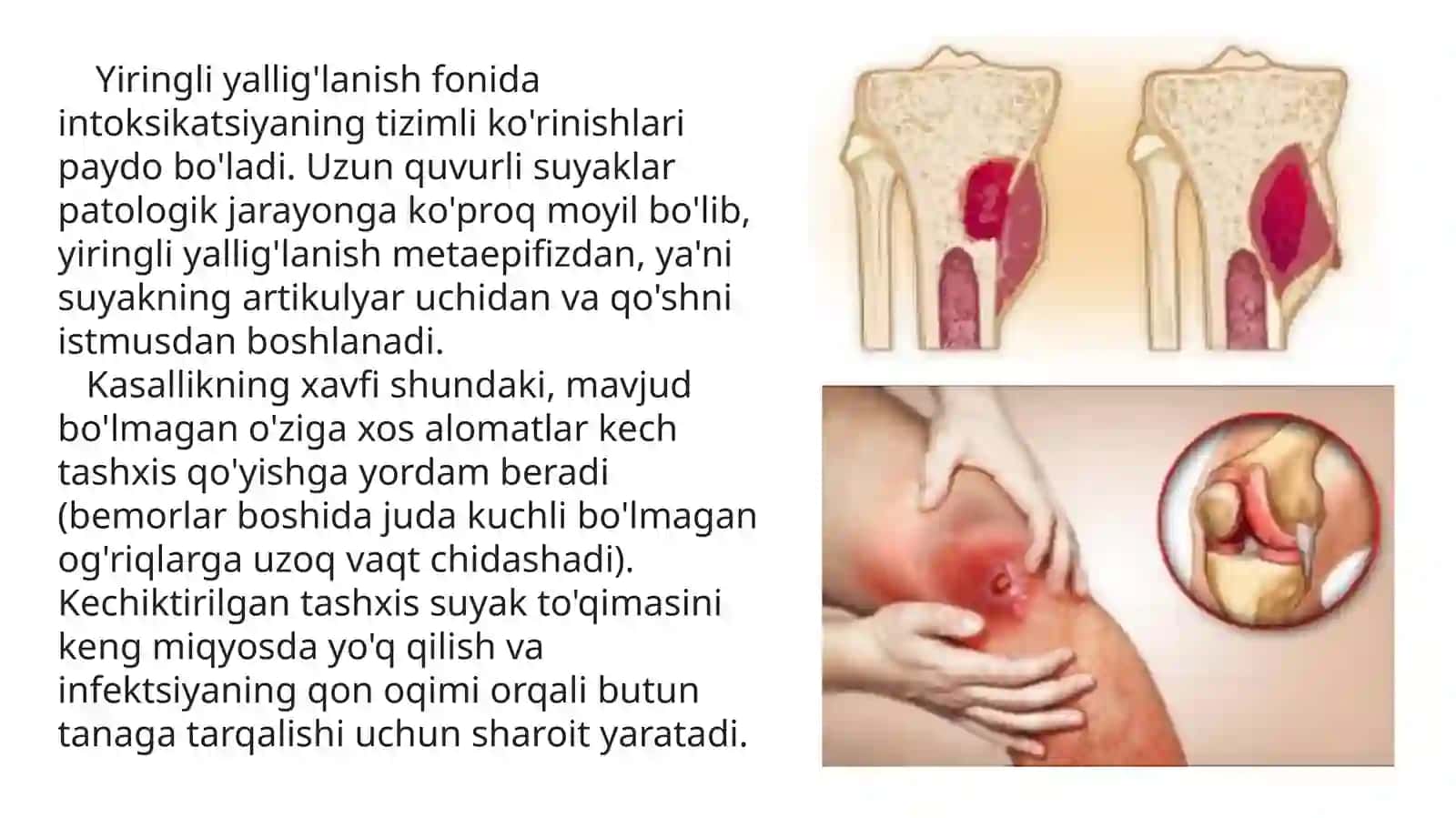 Gematogenli ostemielit 3