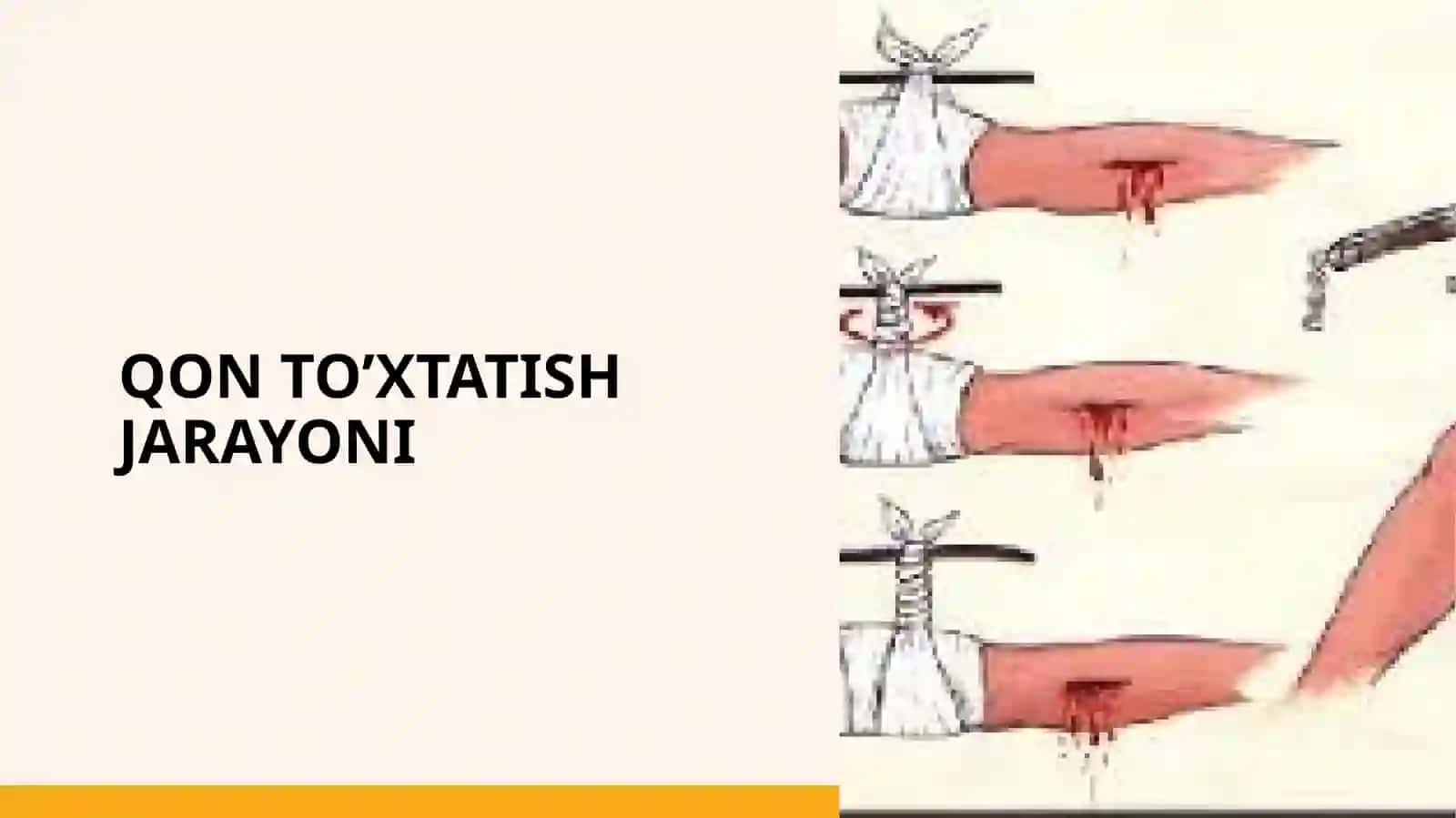 Qon to'xtatish usullarida zamonaviy stendlardan foydalanish umumiy xirurgiyadan 3