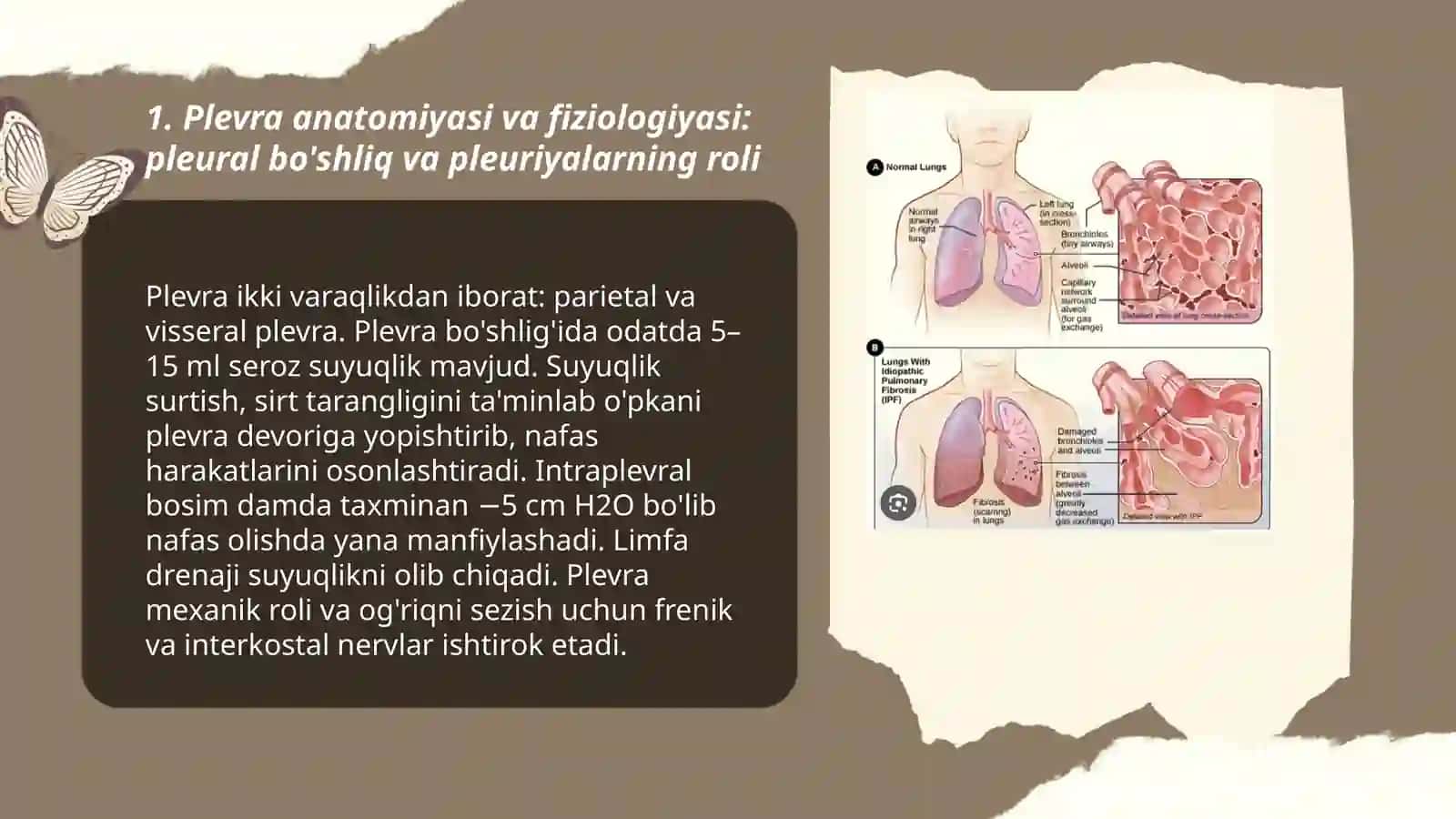 Plevra bo'shlig'ida havo va suyuqlik to'planish sindromi (plevrit, gidrotoraks, pnevmotoraks) 3