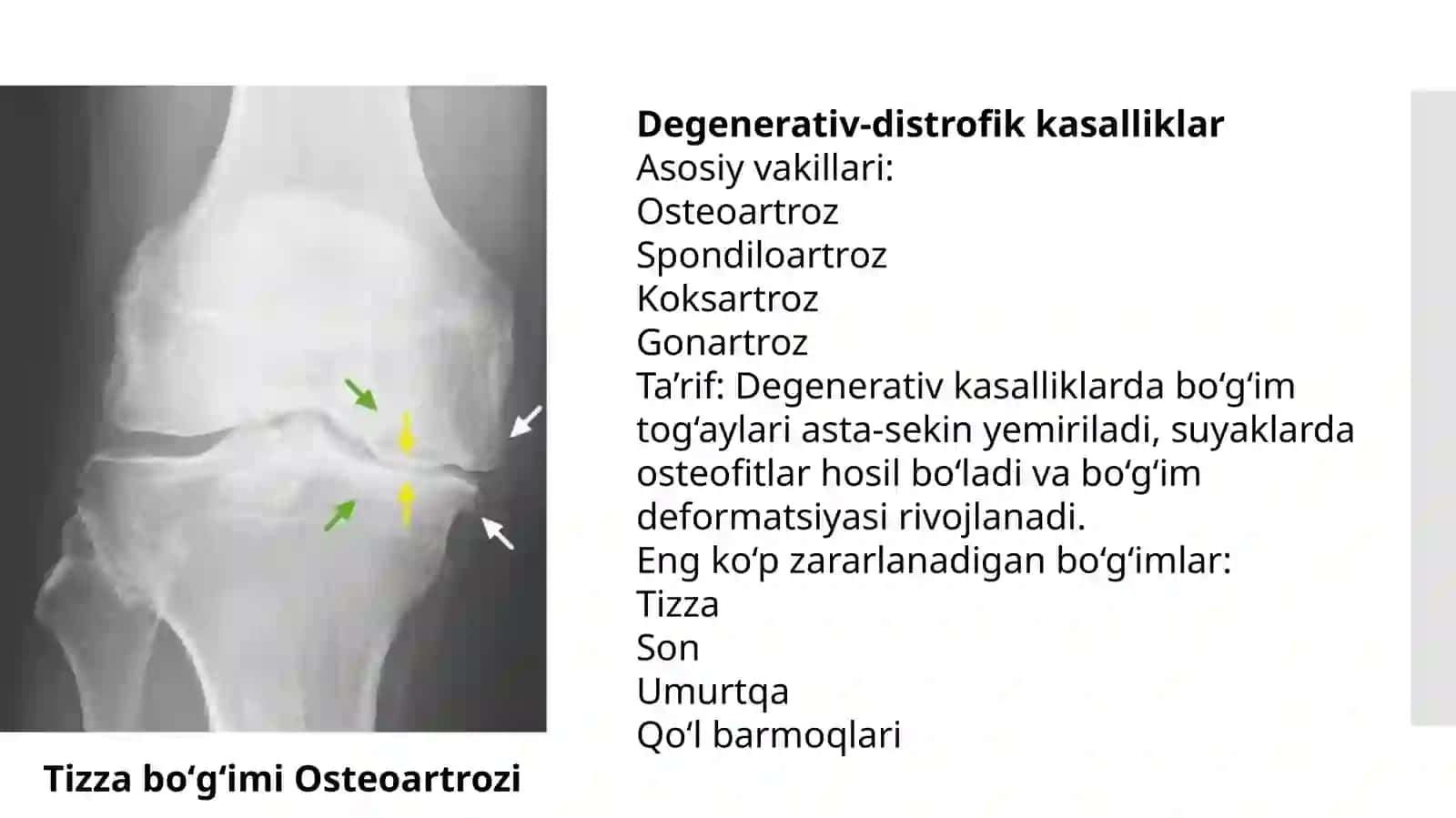 Boʻgʻimlarni degenerativ distrofik yalligʻlanish kasalliklari. 3
