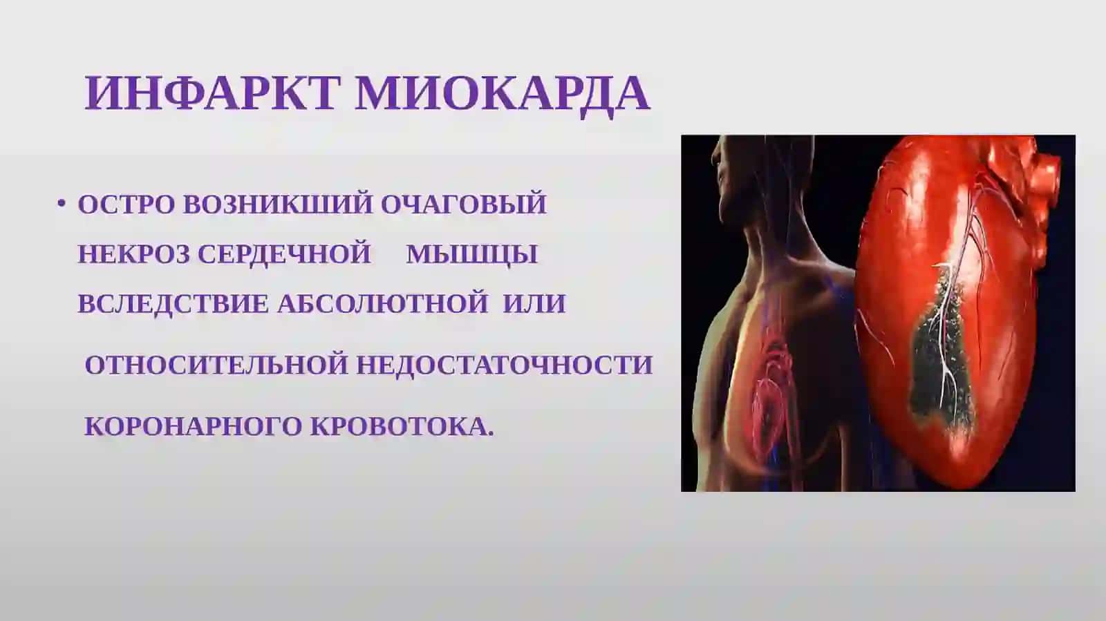 ИНФАРКТМИОКАРДА 3