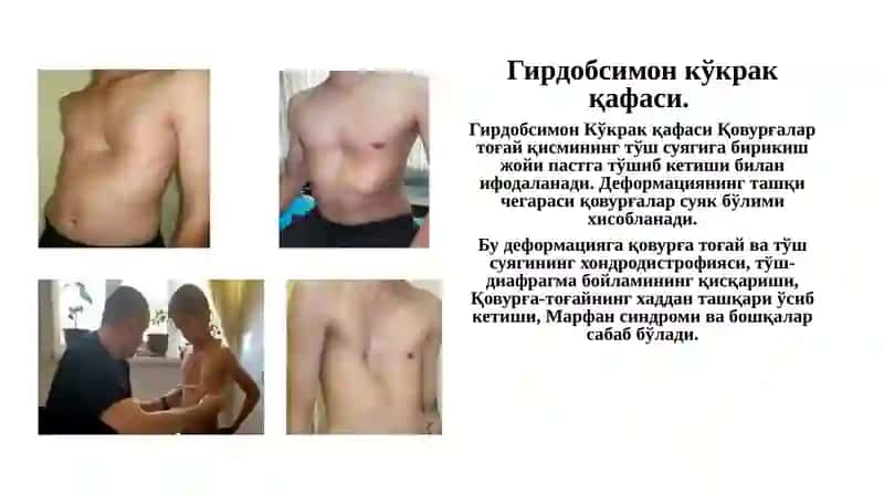 Кўкрак қафаси ва ўпканинг туғма ривожланиш нуқсонлари ва аномалиялари 3