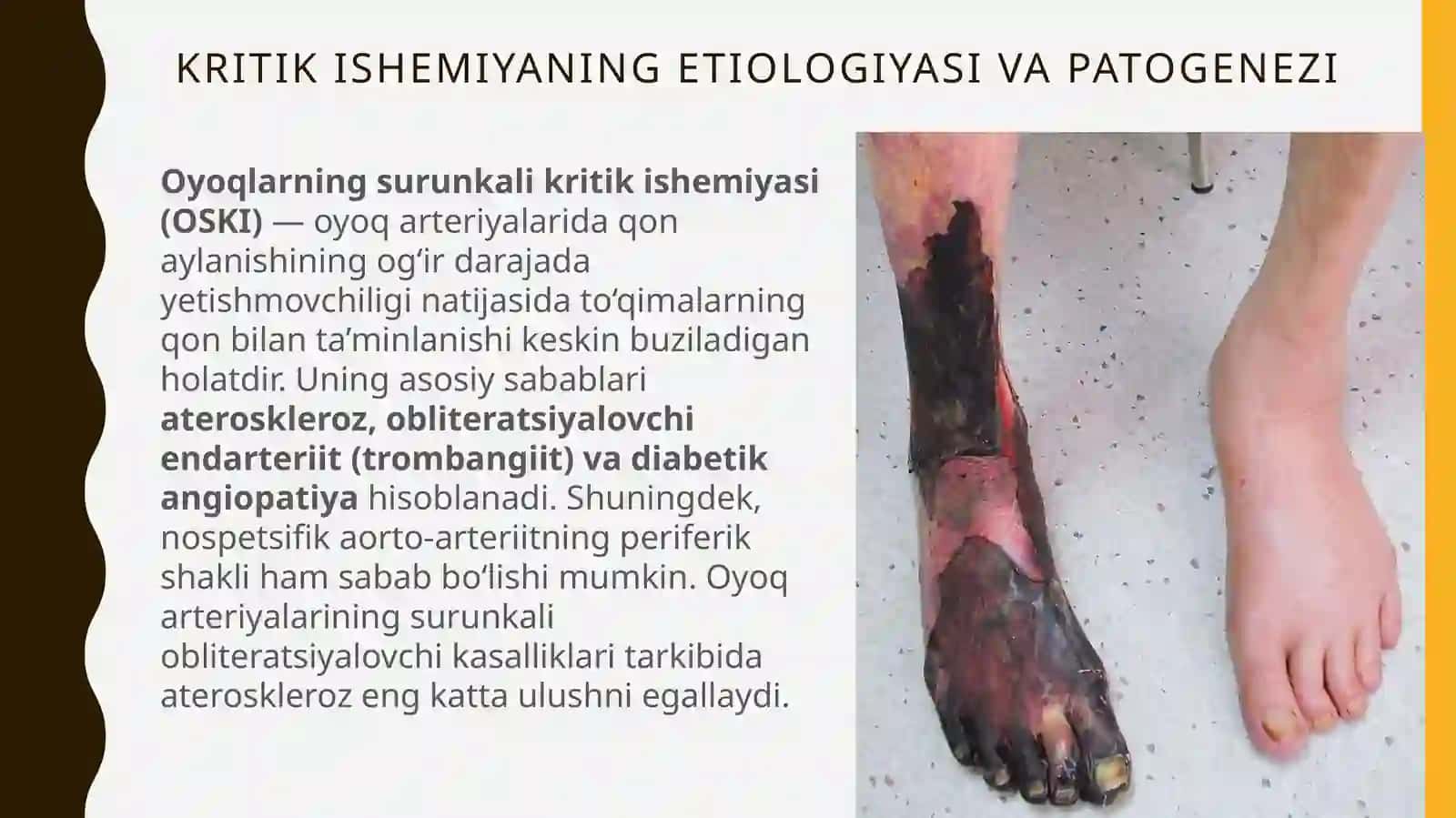 QO‘L-OYOQLAR KRITIK ISHEMIYASI 3