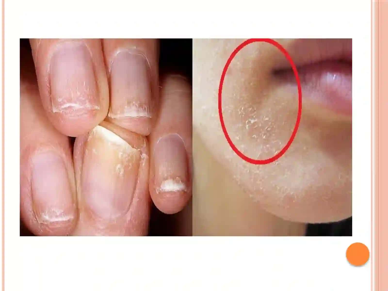 Avitaminozlar. Pellagra 3