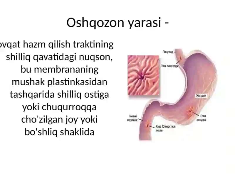 Oshqozon yarasi 3
