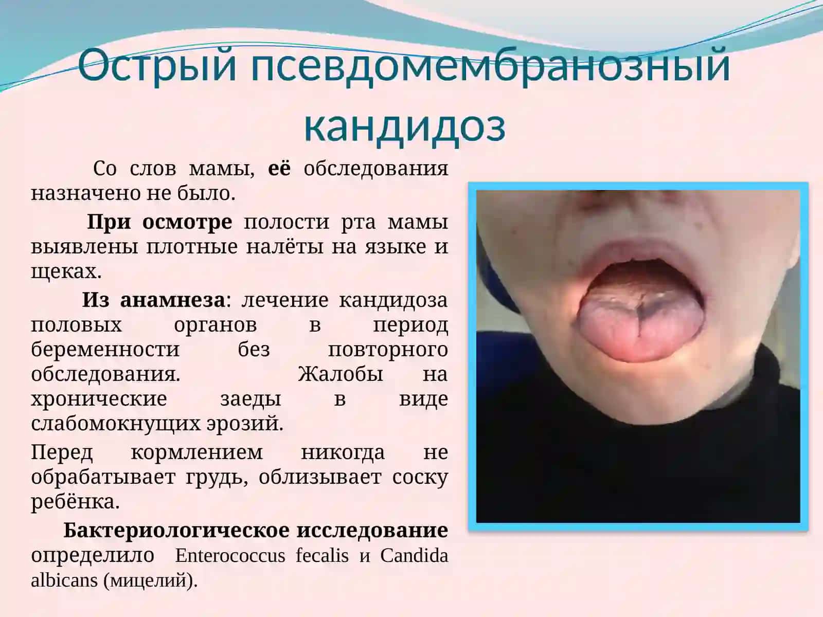 Кандидозы полости рта у новорожденных и детей раннего возраста 3